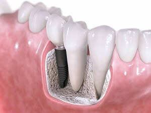 Dental implants 3D