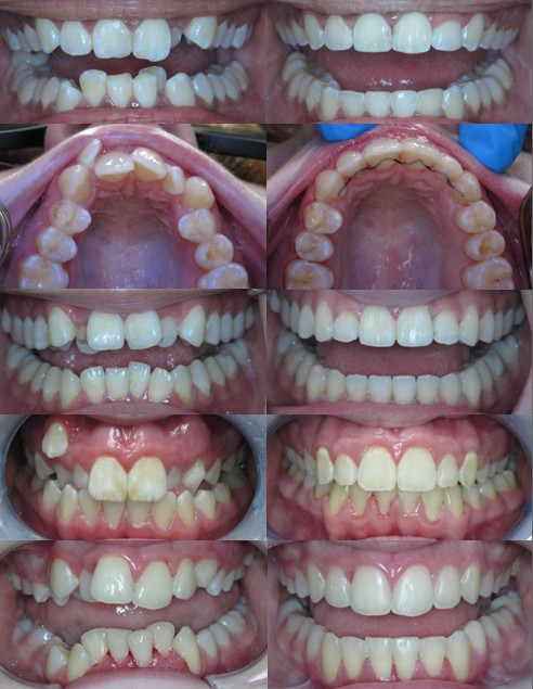 Orthodontics – Braces & Lingual Braces (invisible) - Advanced